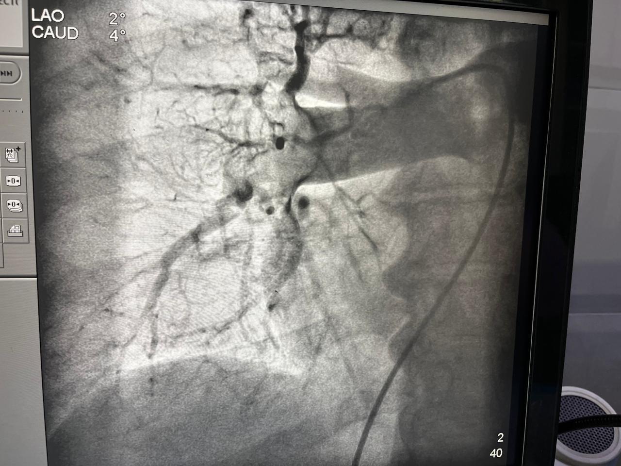 Pulmonary Thrombectomy Image 1