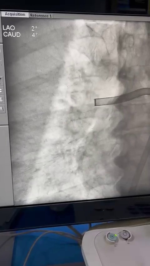 Pulmonary Thrombectomy Video 3