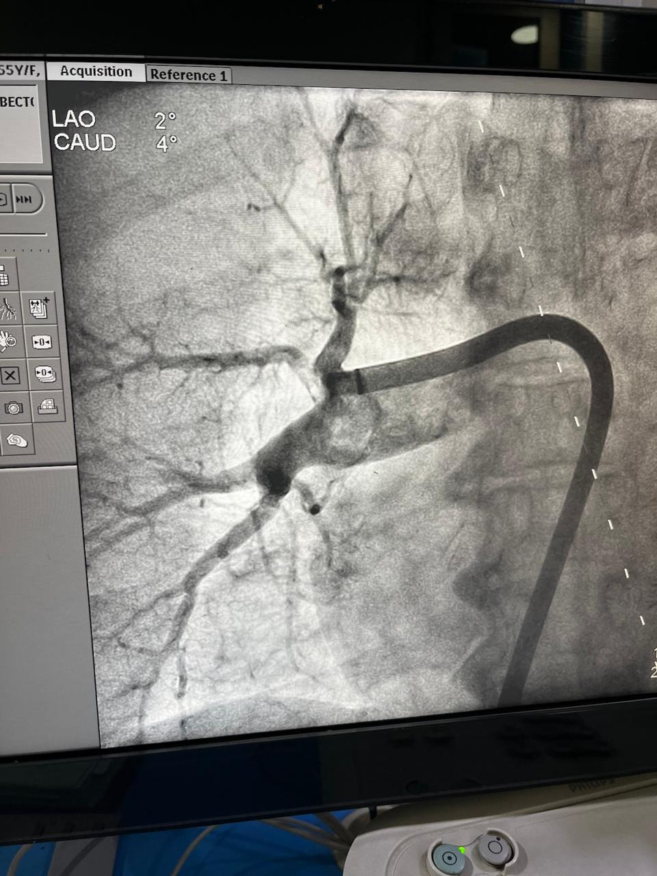 Pulmonary Thrombectomy Image 1