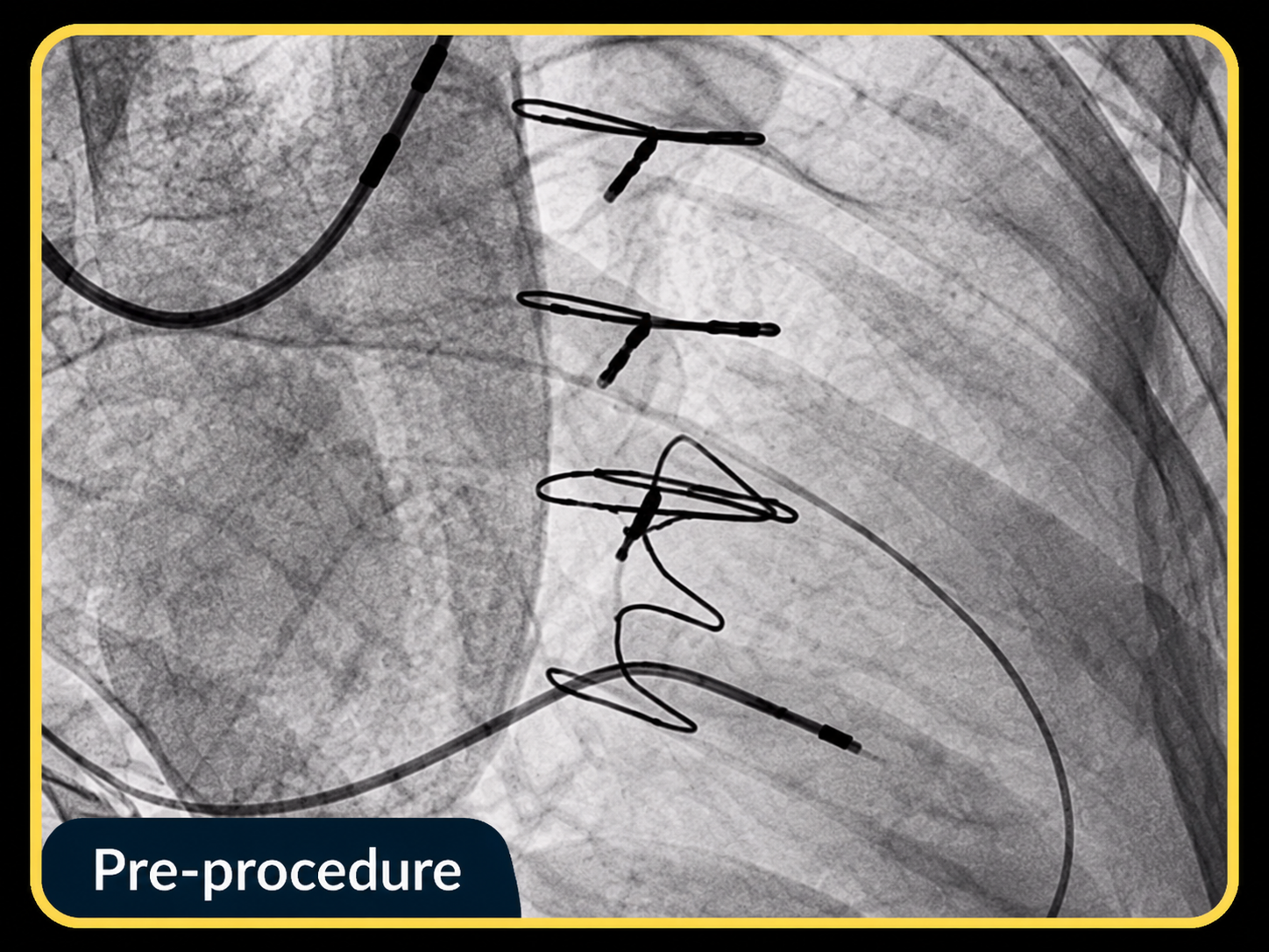 Valve-in-Valve Positioning inside Failed Mitral Ring