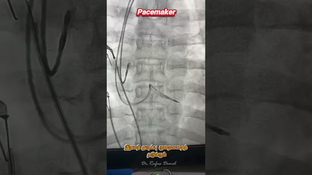Types of Pacemaker & Their Clinical Uses